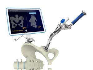 Computer Assisted Hip Replacement