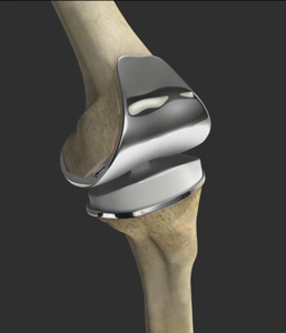 Correction of a Loose Knee Replacement