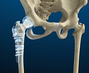 Revision Hip Replacement