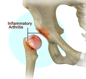 Hip Tendonitis