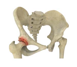 Osteoarthritis of
                                        the Hip