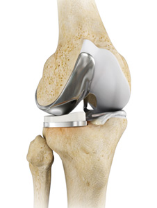 Partial Lateral Knee Replacement